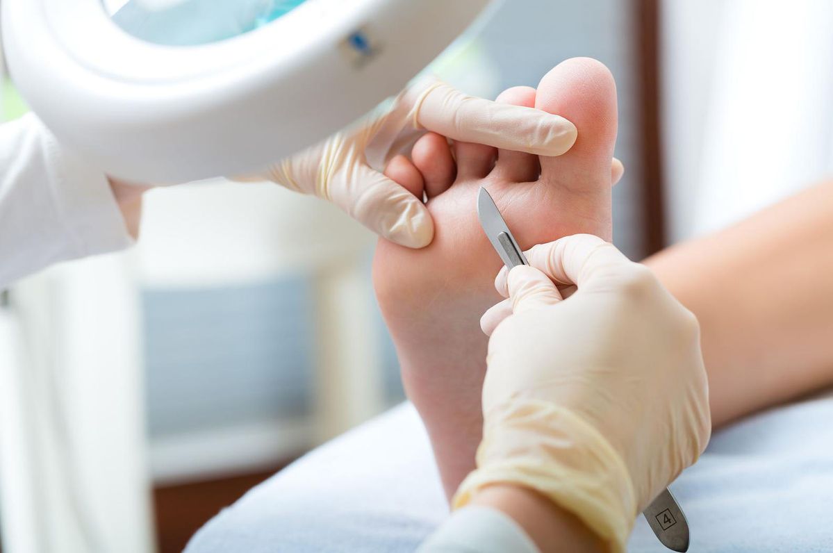 Tratamiento de Hongos y Callos en CDMX - Podología Clínica CDMX