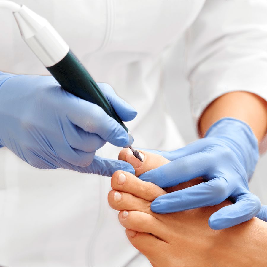 Tratamiento de Uña Encarnada en CDMX - Podología Clínica CDMX
